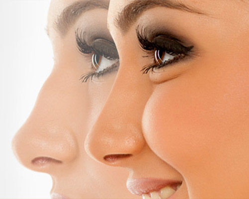 Juvederm For Non-Surgical Rhinoplasty