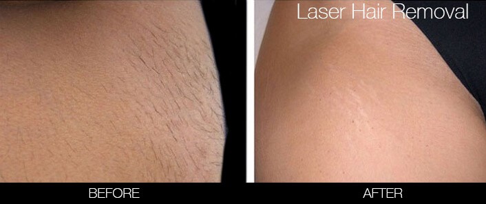 Brazilian Laser Hair Removal Before And After
