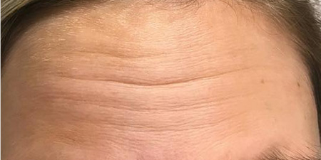 Botox For Forehead Lines