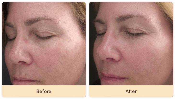 Ipl Photofacial Ipl Photofacial