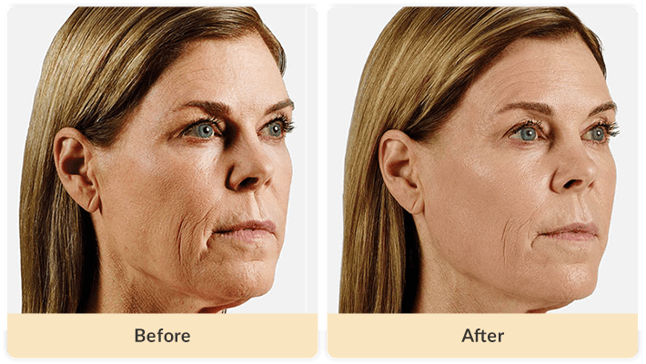 Cheek Filler To Treat Sagging Cheeks Best Cheekbone Filler