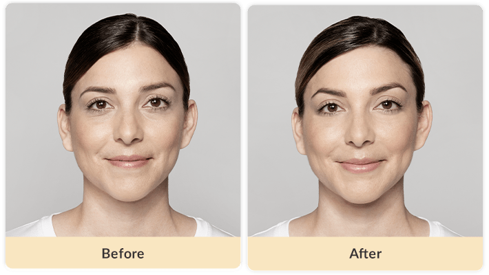 Under Eye Filler Before And After