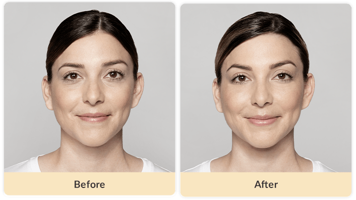 Best Under Eye Filler Treatment For Wrinkles - Before & Afters