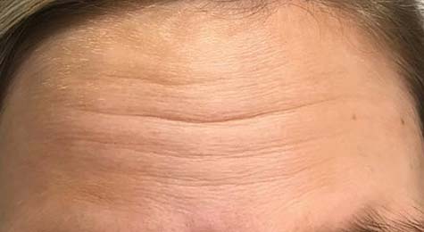 Forehead Line Treatment
