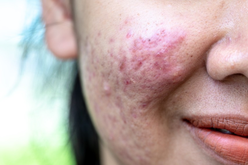 keloid acne scars treatment