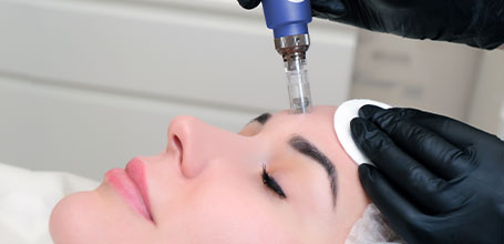 Microneedling For Acne Scars