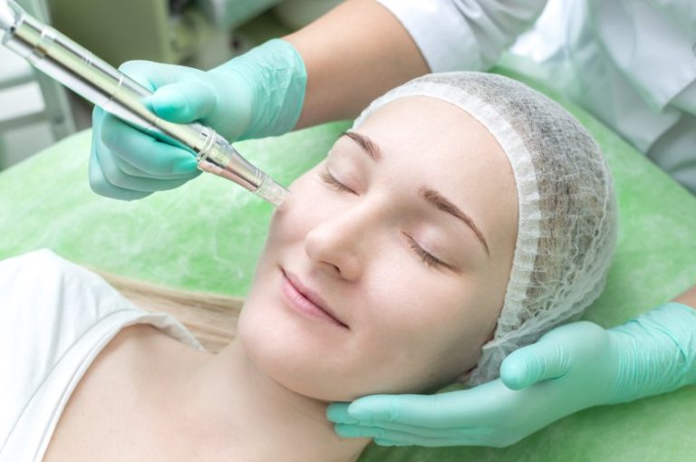 Microneedling Ice Pick Acne Scar Treatment A Detailed Guide