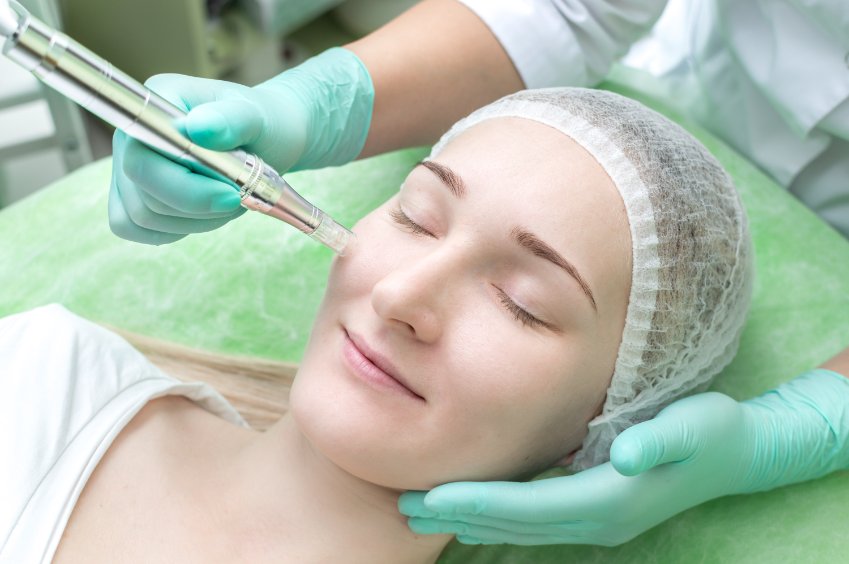 microneedling acne scar treatment