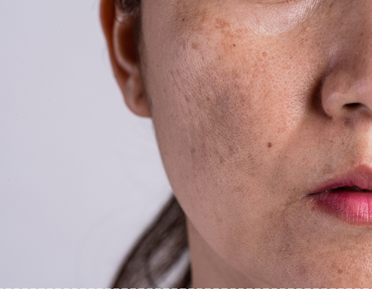 microneedling for skin pigmentation