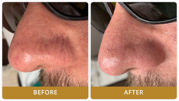 Spider Vein Treatment Before And After