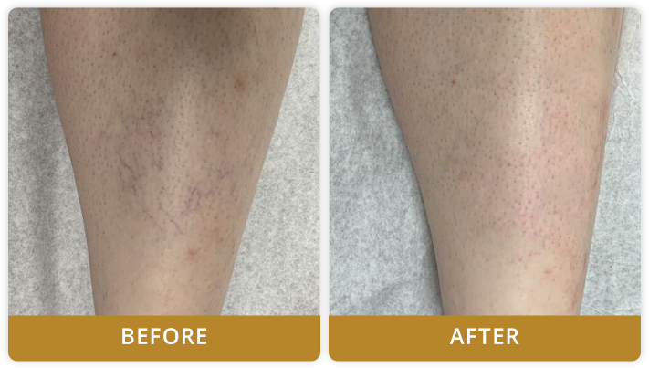 Spider Vein Treatment Before And After