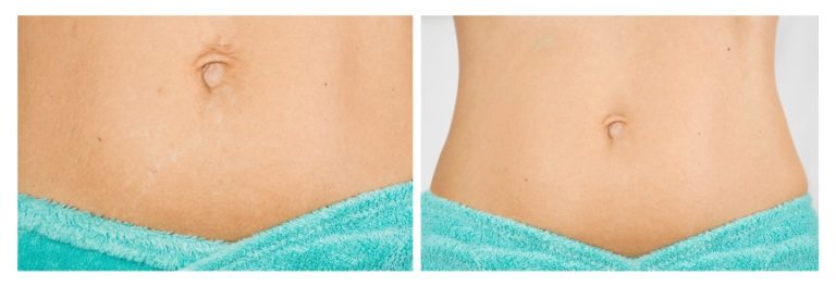 Microneedling For Stretch Marks A Minimally Invasive Treatment 1436