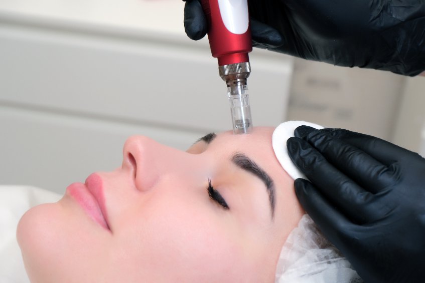 Microneedling for ice pick scars